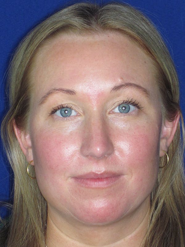 Rhinoplasty Before & After Gallery - Patient 165412510 - Image 4