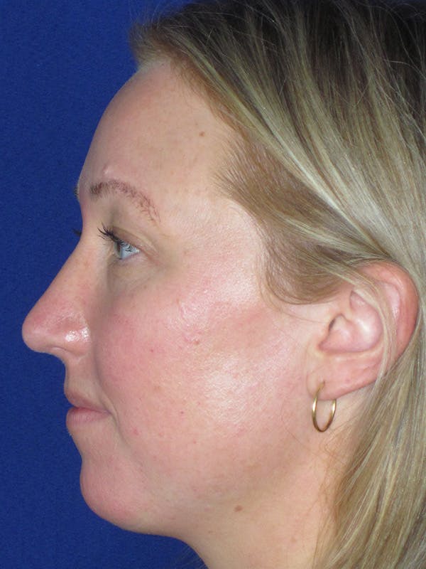 Rhinoplasty Before & After Gallery - Patient 165412510 - Image 6