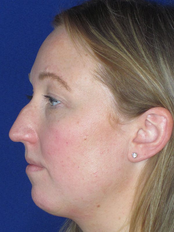 Rhinoplasty Before & After Gallery - Patient 165412510 - Image 5