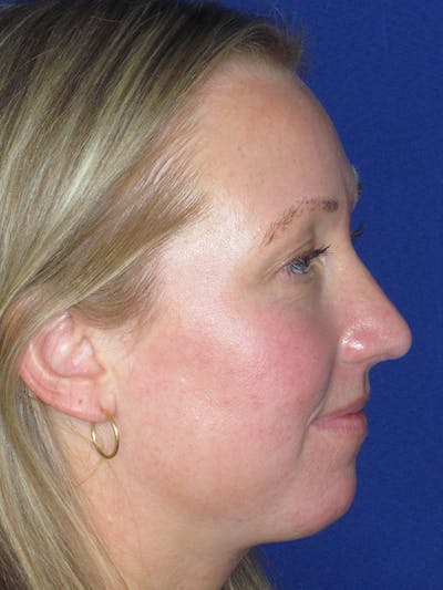 Rhinoplasty Before & After Gallery - Patient 165412510 - Image 2