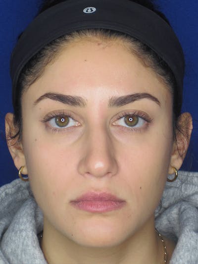 Rhinoplasty Before & After Gallery - Patient 165413253 - Image 1