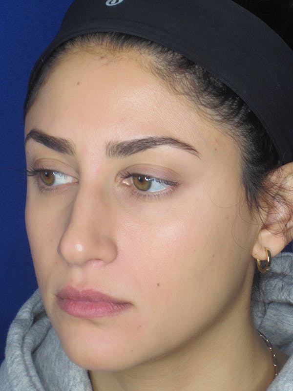 Rhinoplasty Before & After Gallery - Patient 165413253 - Image 5