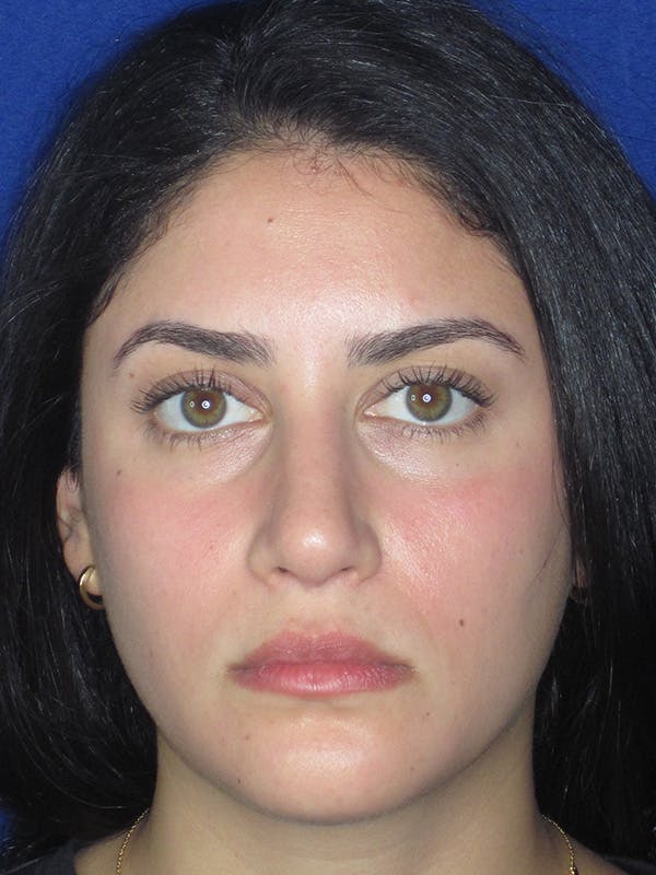 Rhinoplasty Before & After Gallery - Patient 165413253 - Image 2