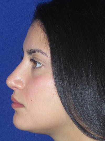 Rhinoplasty Before & After Gallery - Patient 165413253 - Image 8