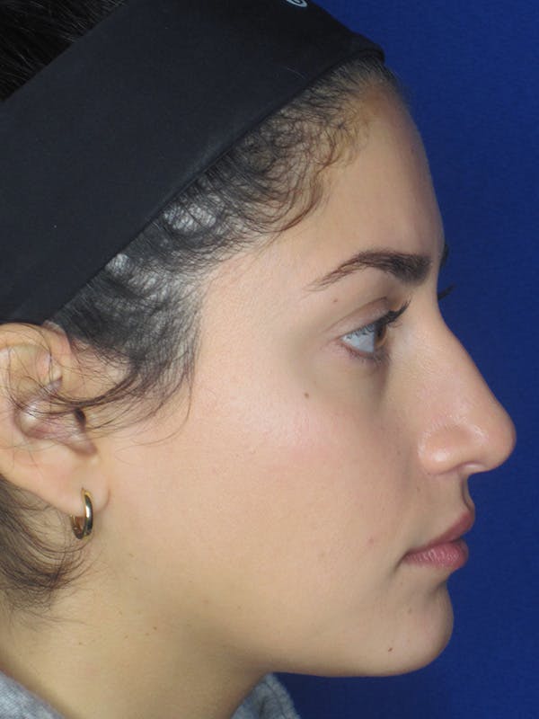 Rhinoplasty Before & After Gallery - Patient 165413253 - Image 3