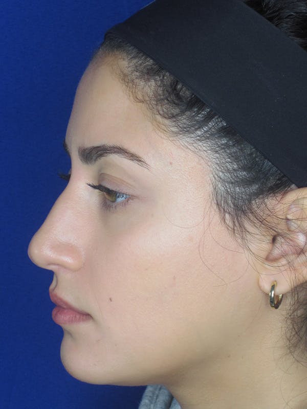 Rhinoplasty Before & After Gallery - Patient 165413253 - Image 7
