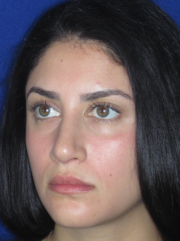 Rhinoplasty Before & After Gallery - Patient 165413253 - Image 6