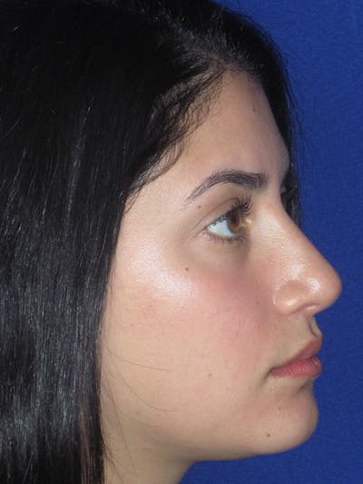 Rhinoplasty Before & After Gallery - Patient 165413253 - Image 4