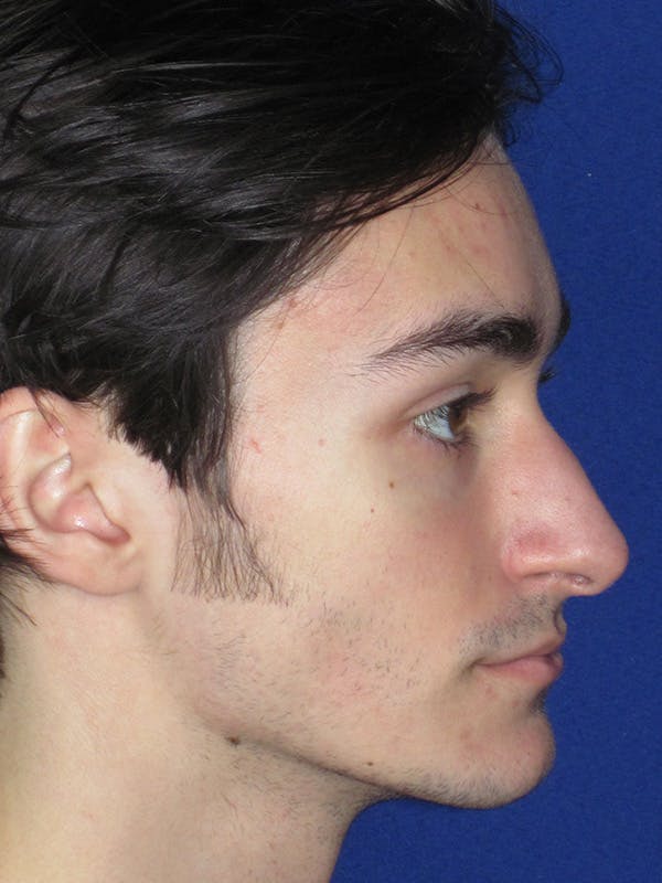 Rhinoplasty Before & After Gallery - Patient 165416664 - Image 3