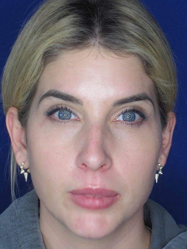 Rhinoplasty Before & After Gallery - Patient 165412508 - Image 5
