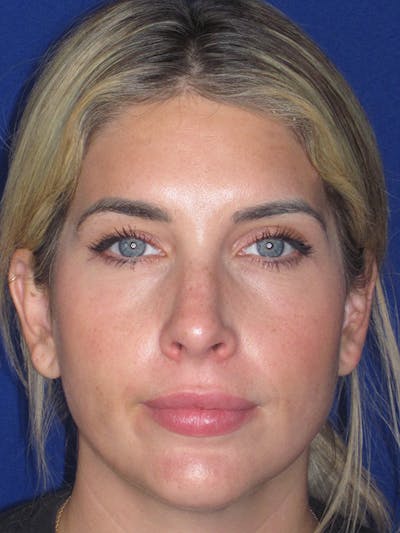 Rhinoplasty Before & After Gallery - Patient 165412508 - Image 6