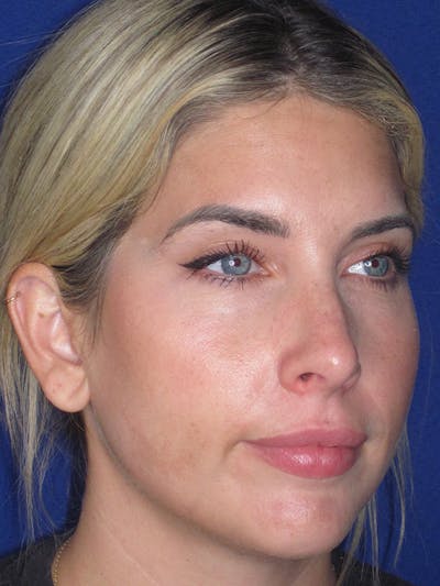 Rhinoplasty Before & After Gallery - Patient 165412508 - Image 2