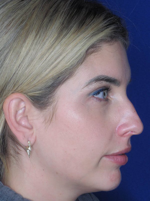 Rhinoplasty Before & After Gallery - Patient 165412508 - Image 7