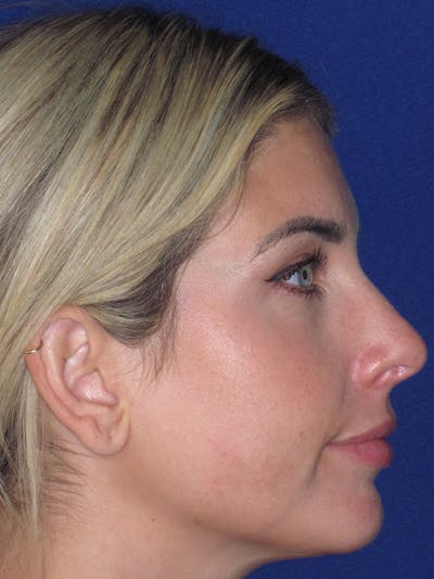 Rhinoplasty Before & After Gallery - Patient 165412508 - Image 8