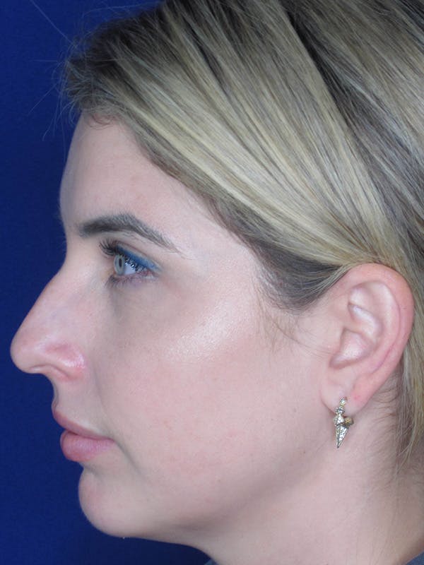 Rhinoplasty Before & After Gallery - Patient 165412508 - Image 3