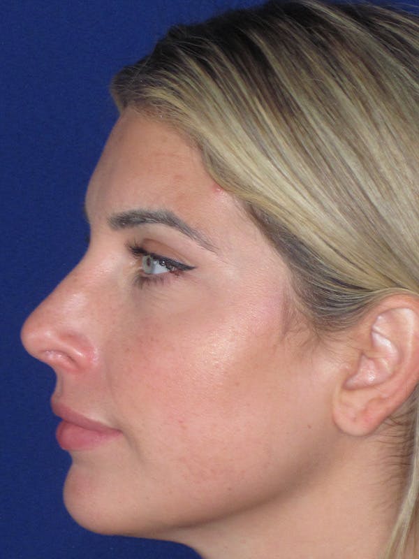 Rhinoplasty Before & After Gallery - Patient 165412508 - Image 4