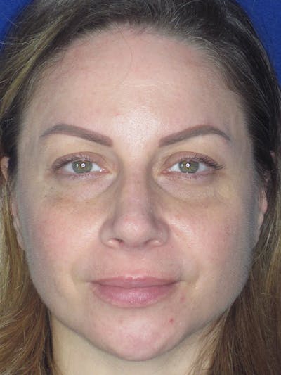 Rhinoplasty Before & After Gallery - Patient 165412509 - Image 4