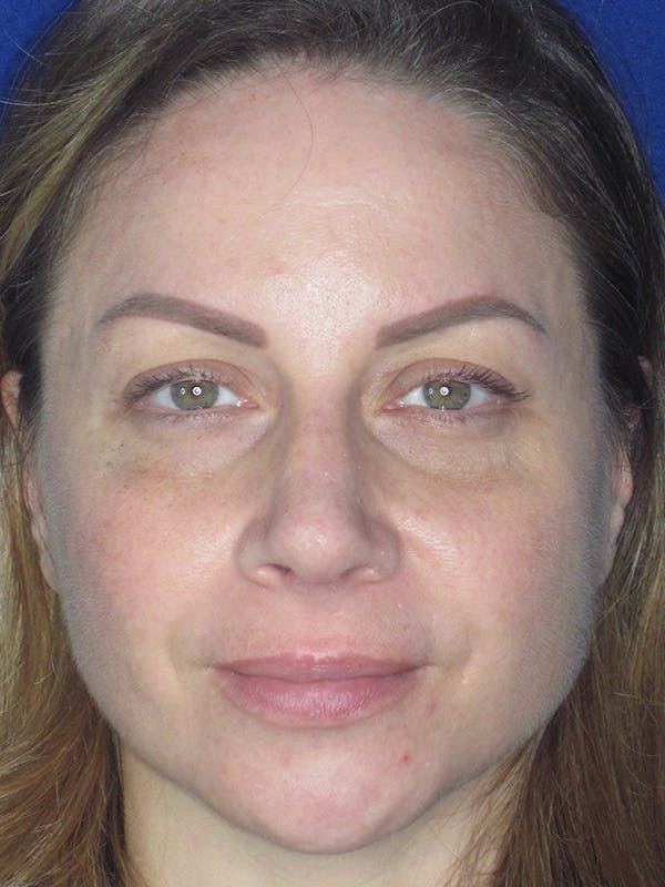Rhinoplasty Before & After Gallery - Patient 165412509 - Image 4
