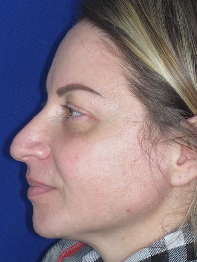 Rhinoplasty Before & After Gallery - Patient 165412509 - Image 1