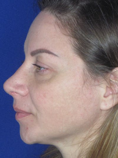 Rhinoplasty Before & After Gallery - Patient 165412509 - Image 2