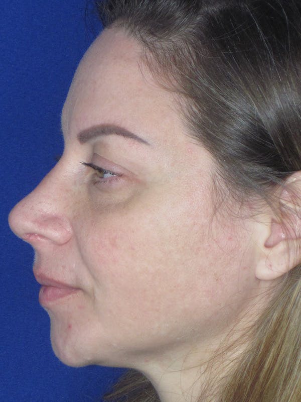 Rhinoplasty Before & After Gallery - Patient 165412509 - Image 2