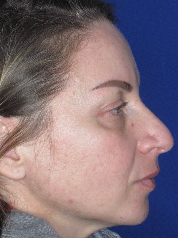 Rhinoplasty Before & After Gallery - Patient 165412509 - Image 7