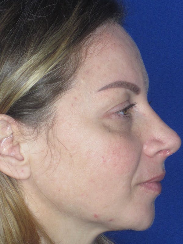 Rhinoplasty Before & After Gallery - Patient 165412509 - Image 8
