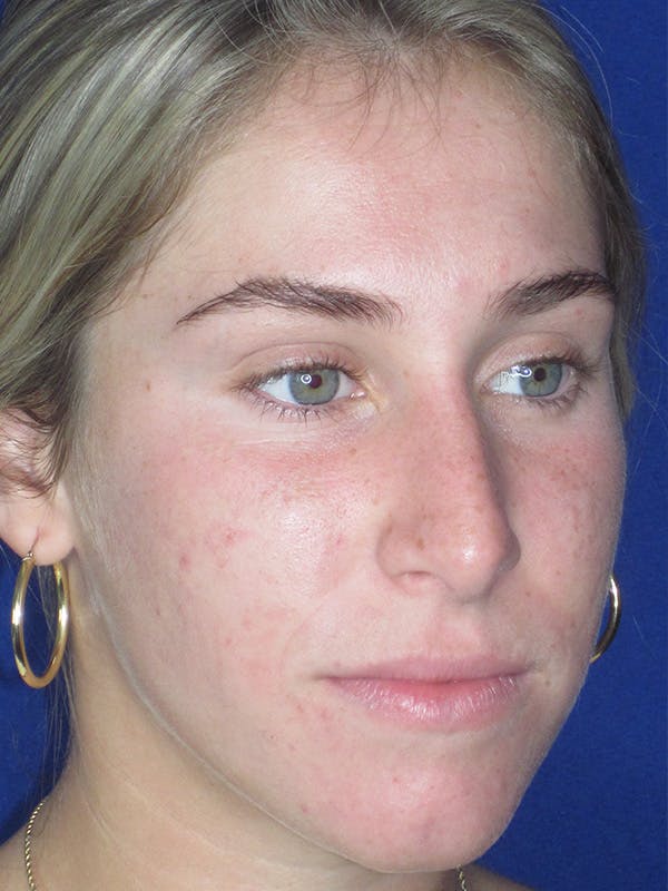 Rhinoplasty Before & After Gallery - Patient 165413234 - Image 5