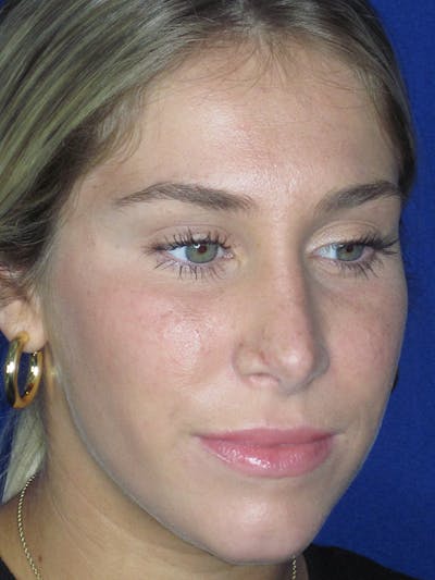 Rhinoplasty Before & After Gallery - Patient 165413234 - Image 6
