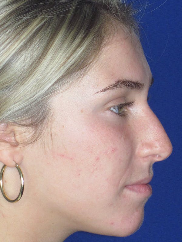 Rhinoplasty Before & After Gallery - Patient 165413234 - Image 7
