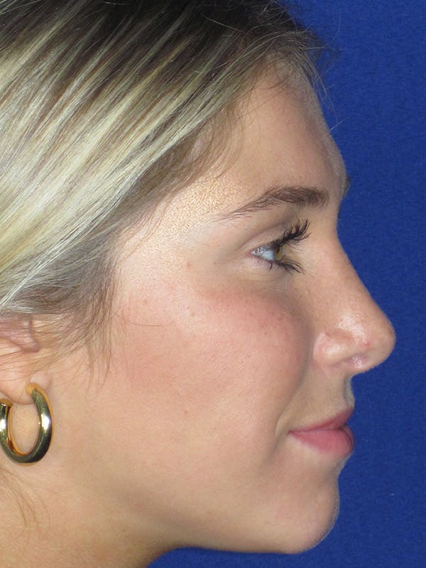 Rhinoplasty Before & After Gallery - Patient 165413234 - Image 8