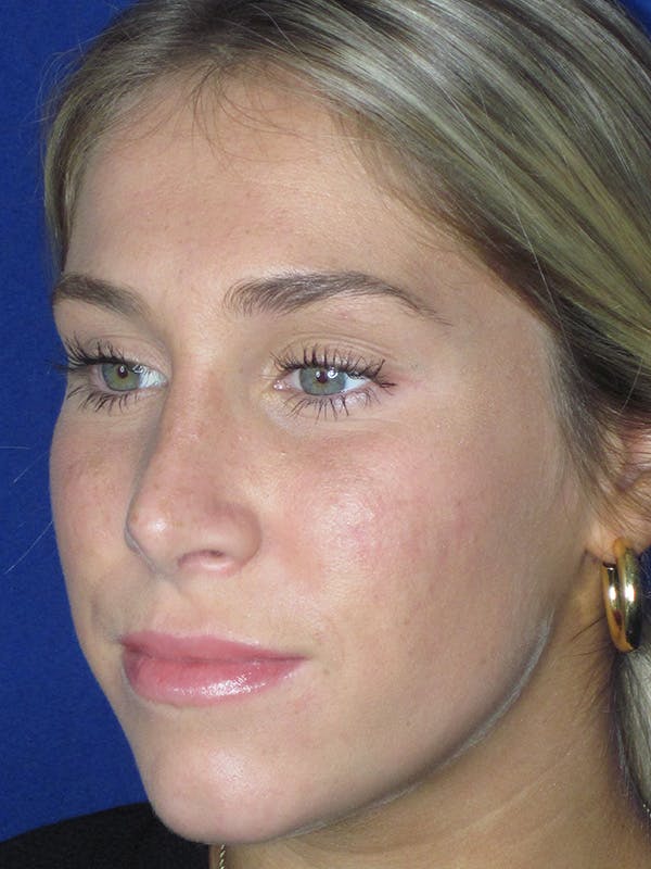 Rhinoplasty Before & After Gallery - Patient 165413234 - Image 3