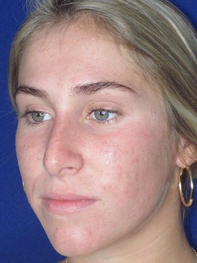 Rhinoplasty Before & After Gallery - Patient 165413234 - Image 4