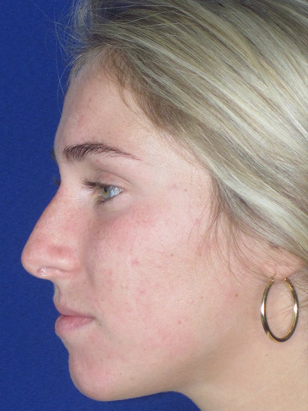 Rhinoplasty Before & After Gallery - Patient 165413234 - Image 1