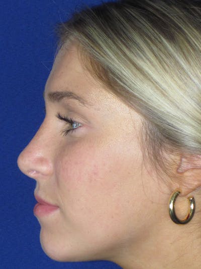 Rhinoplasty Before & After Gallery - Patient 165413234 - Image 2