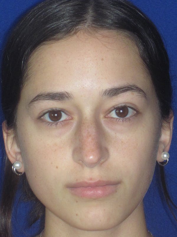 Rhinoplasty Before & After Gallery - Patient 165413235 - Image 5