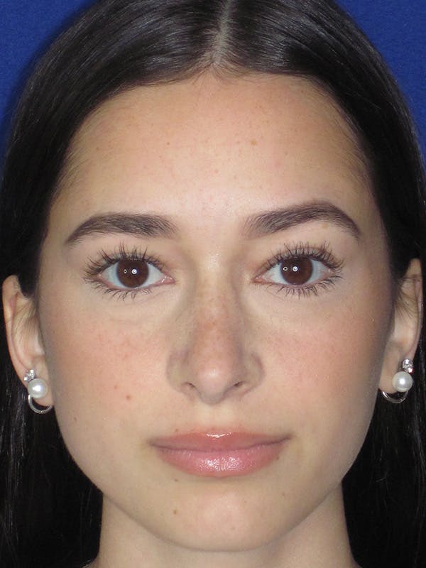 Rhinoplasty Before & After Gallery - Patient 165413235 - Image 6