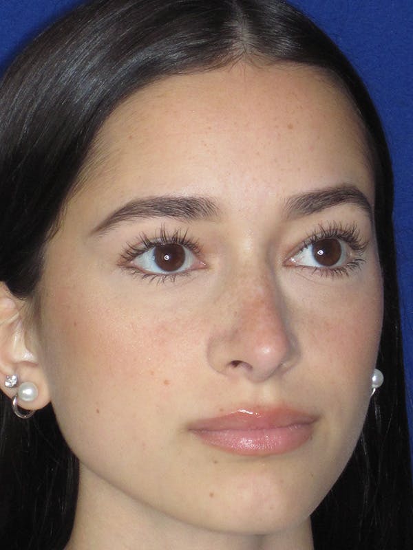 Rhinoplasty Before & After Gallery - Patient 165413235 - Image 4