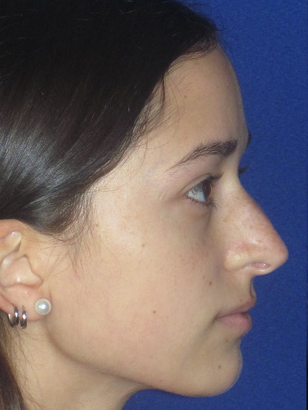 Rhinoplasty Before & After Gallery - Patient 165413235 - Image 1