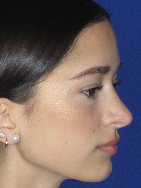 Rhinoplasty Before & After Gallery - Patient 165413235 - Image 2
