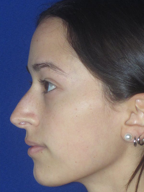 Rhinoplasty Before & After Gallery - Patient 165413235 - Image 7