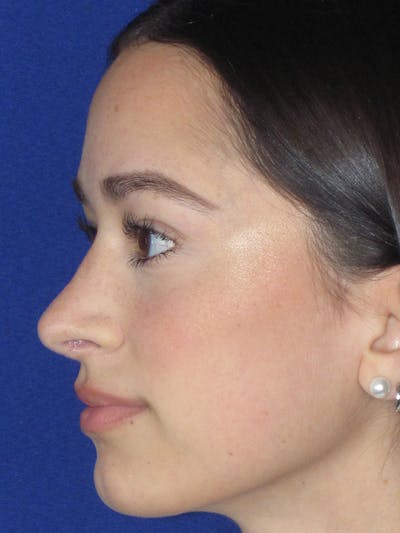 Rhinoplasty Before & After Gallery - Patient 165413235 - Image 8