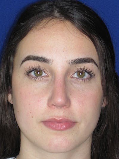 Rhinoplasty Before & After Gallery - Patient 165413236 - Image 8
