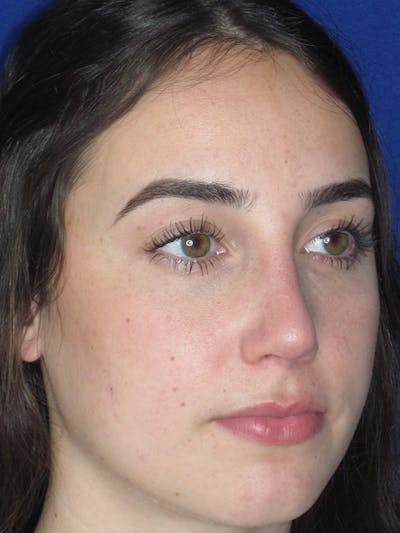 Rhinoplasty Before & After Gallery - Patient 165413236 - Image 6