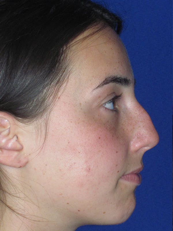 Rhinoplasty Before & After Gallery - Patient 165413236 - Image 1