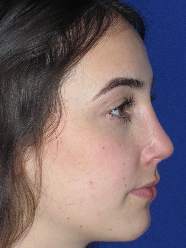 Rhinoplasty Before & After Gallery - Patient 165413236 - Image 2