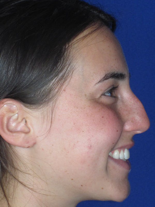 Rhinoplasty Before & After Gallery - Patient 165413236 - Image 3