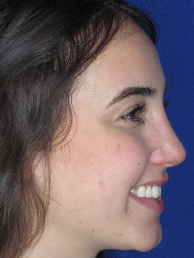 Rhinoplasty Before & After Gallery - Patient 165413236 - Image 4
