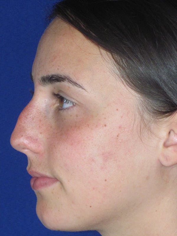 Rhinoplasty Before & After Gallery - Patient 165413236 - Image 9
