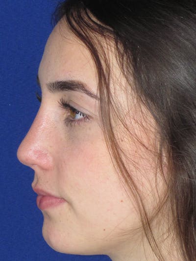 Rhinoplasty Before & After Gallery - Patient 165413236 - Image 10